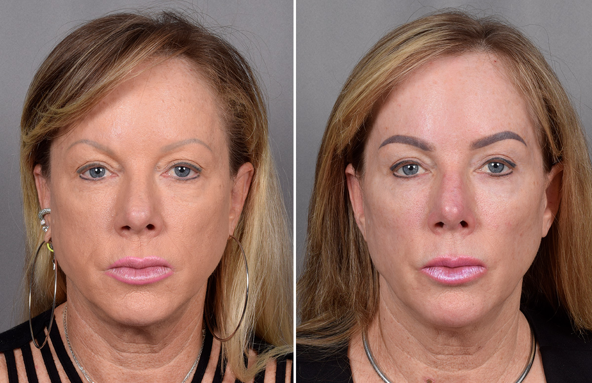 CO2 Laser Before & After Gallery - Patient 401436 - Image 3