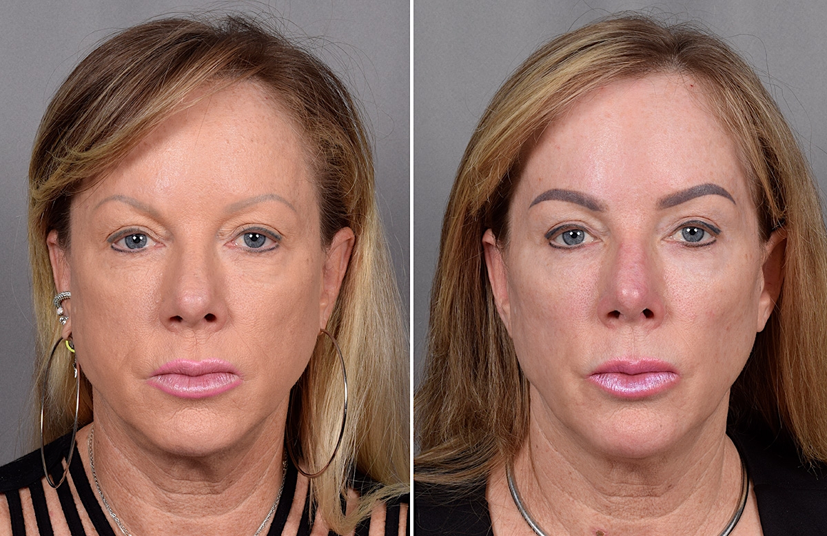 CO2 Laser Before & After Gallery - Patient 401436 - Image 3
