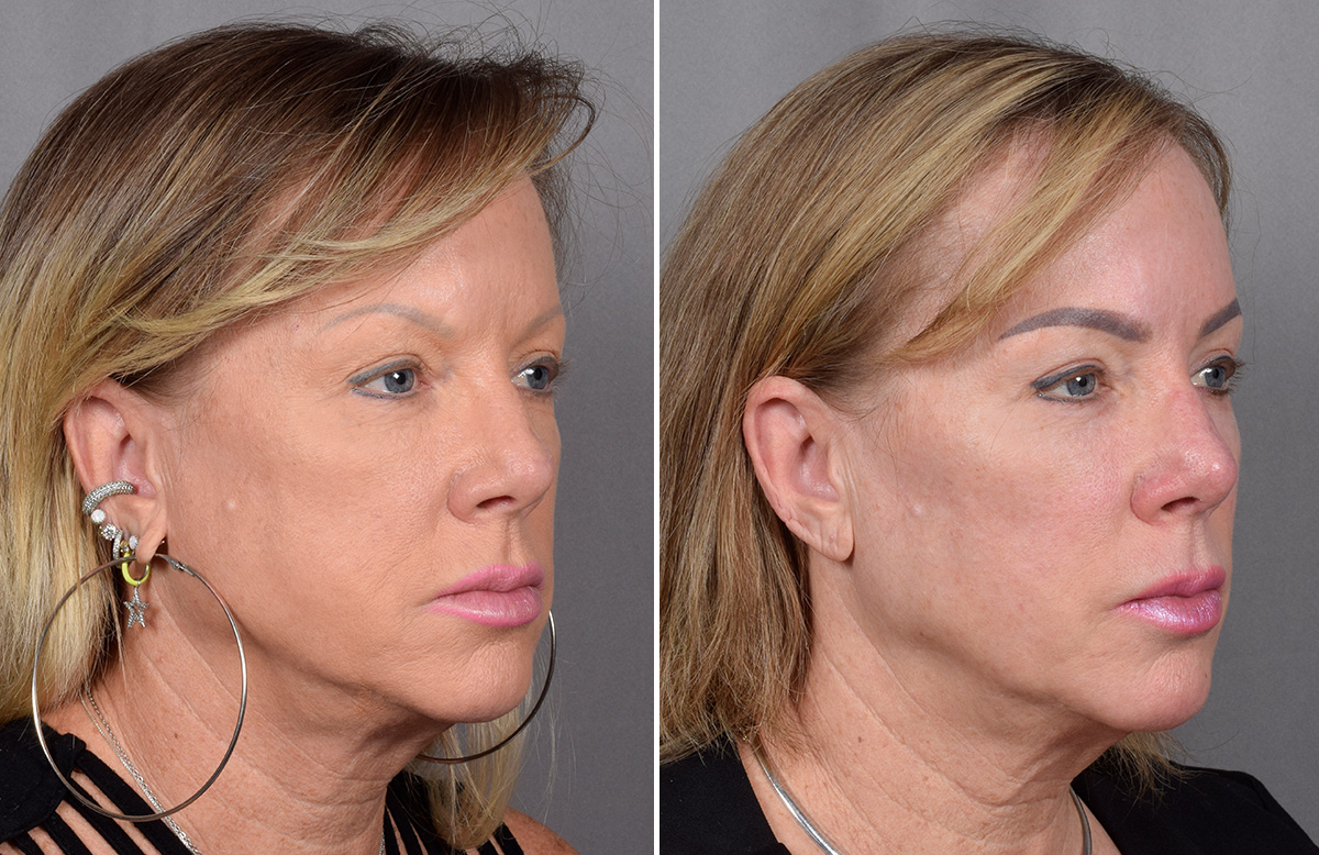 CO2 Laser Before & After Gallery - Patient 401436 - Image 1