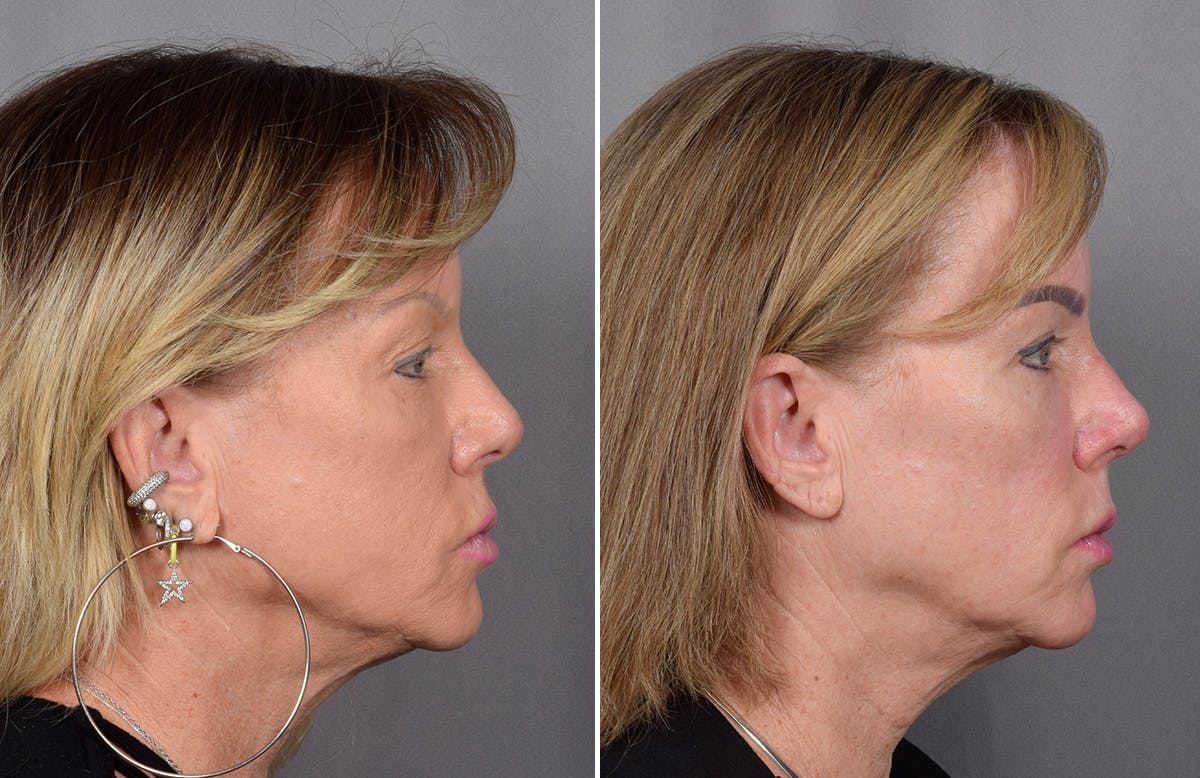 CO2 Laser Before & After Gallery - Patient 401436 - Image 2
