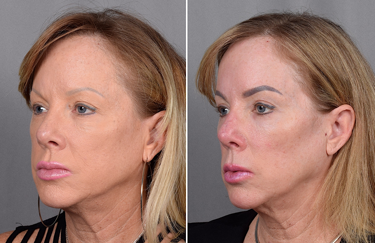 CO2 Laser Before & After Gallery - Patient 401436 - Image 4