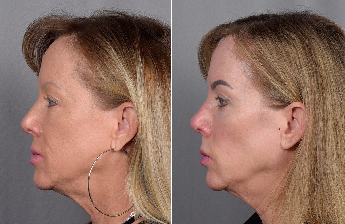 CO2 Laser Before & After Gallery - Patient 401436 - Image 5