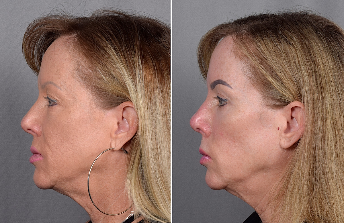 CO2 Laser Before & After Gallery - Patient 401436 - Image 5