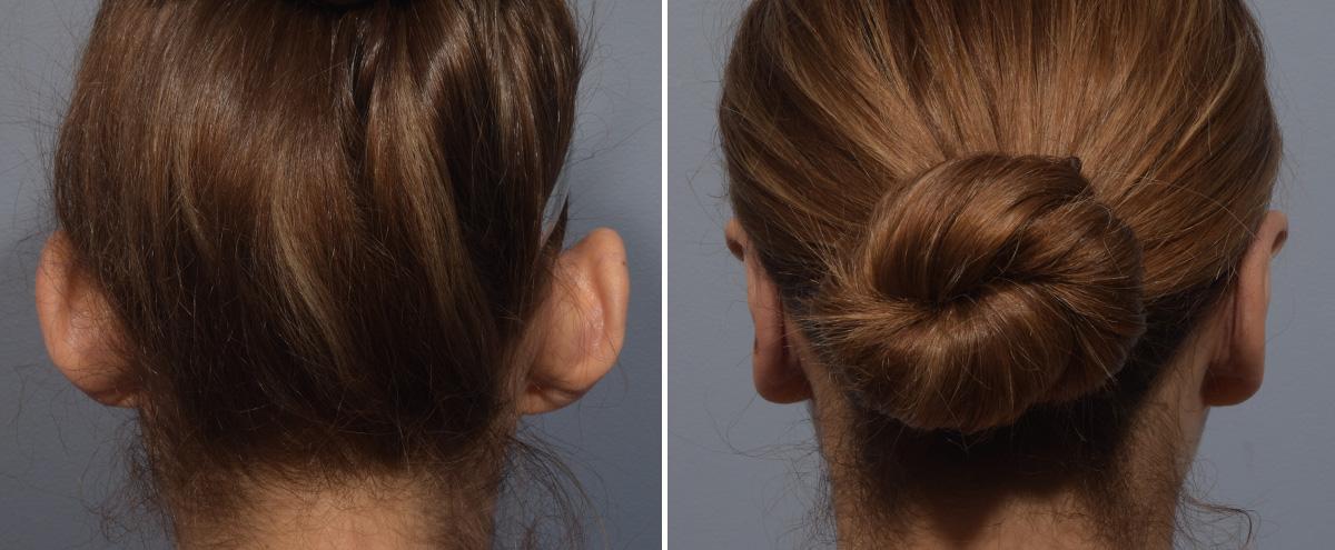 Otoplasty Before & After Gallery - Patient 266253 - Image 6