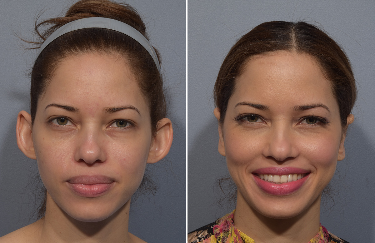 Otoplasty Before & After Gallery - Patient 266253 - Image 1
