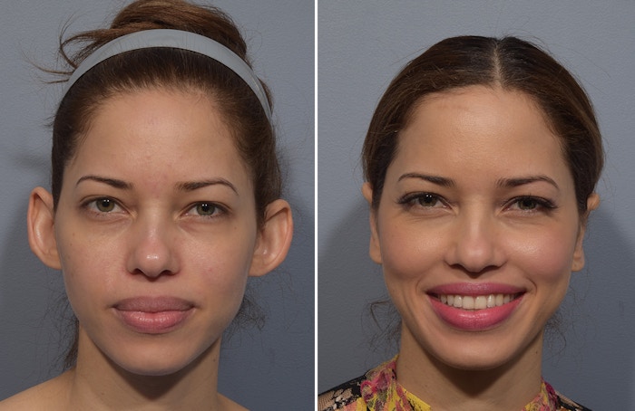 Otoplasty Before & After Gallery - Patient 266253 - Image 1