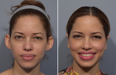 Otoplasty Before & After Gallery - Patient 266253 - Image 1