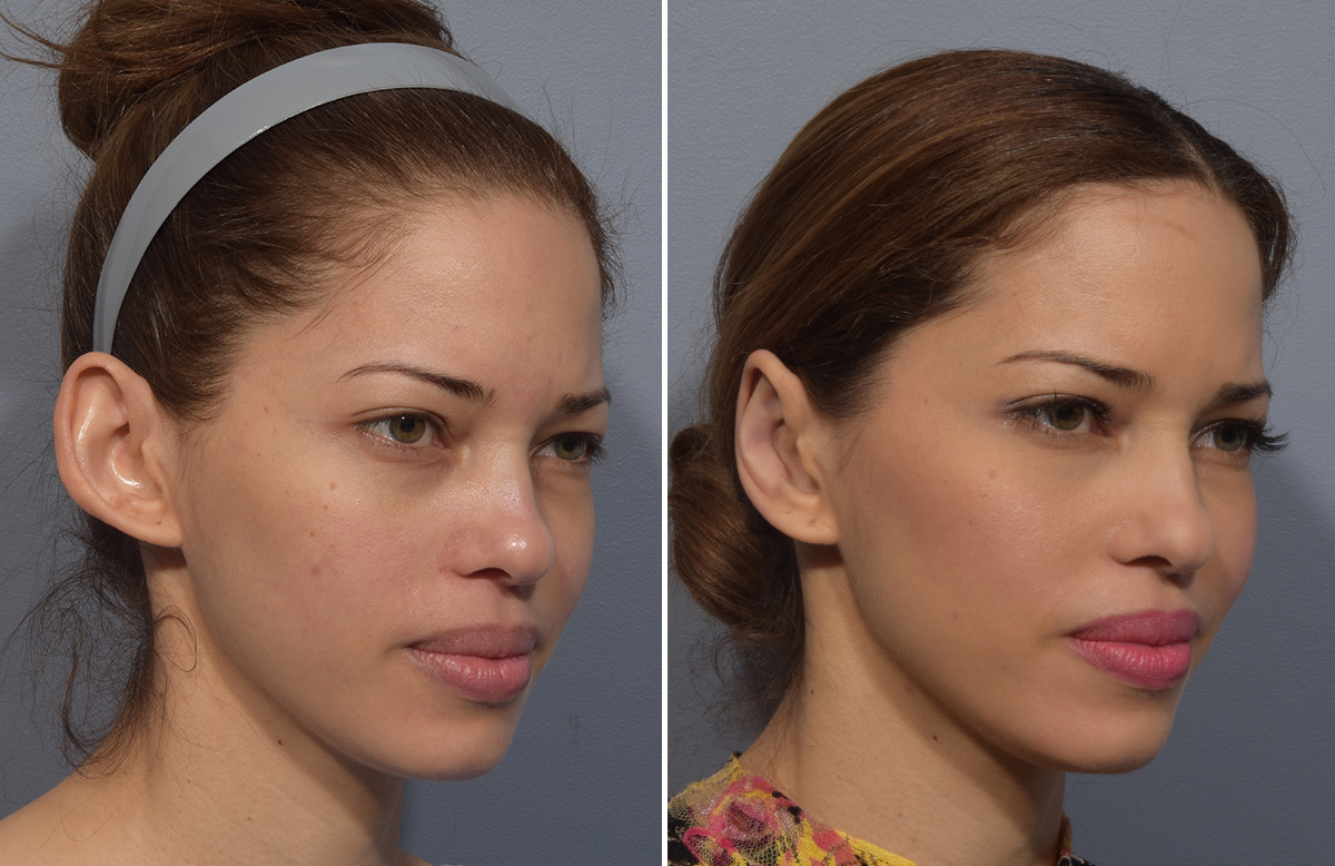 Otoplasty Before & After Gallery - Patient 266253 - Image 2