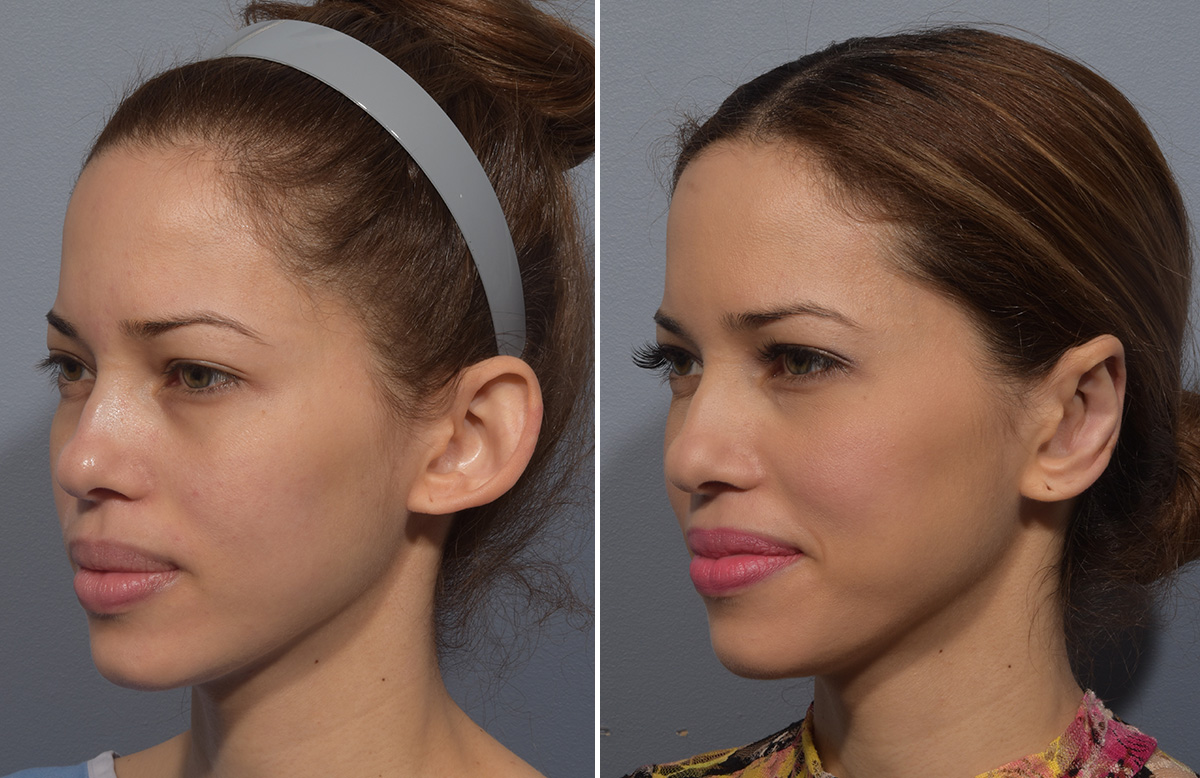 Otoplasty Before & After Gallery - Patient 266253 - Image 4