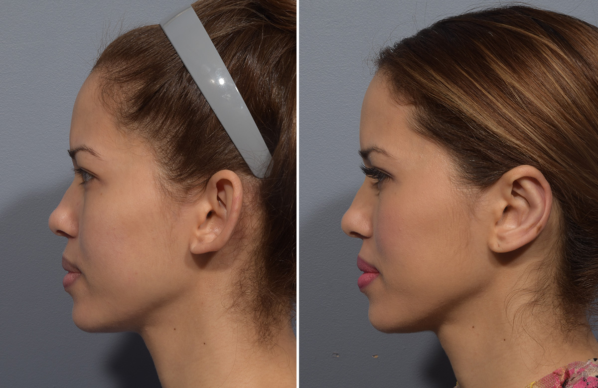 Otoplasty Before & After Gallery - Patient 266253 - Image 5