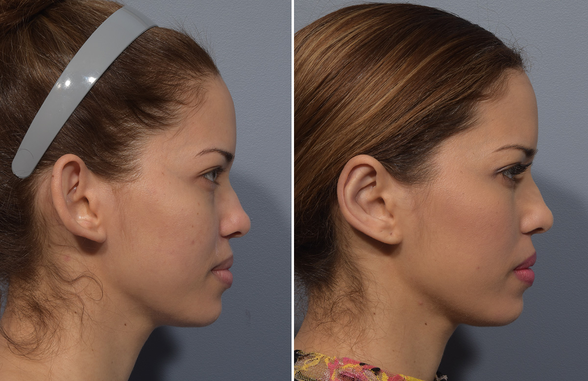 Otoplasty Before & After Gallery - Patient 266253 - Image 3