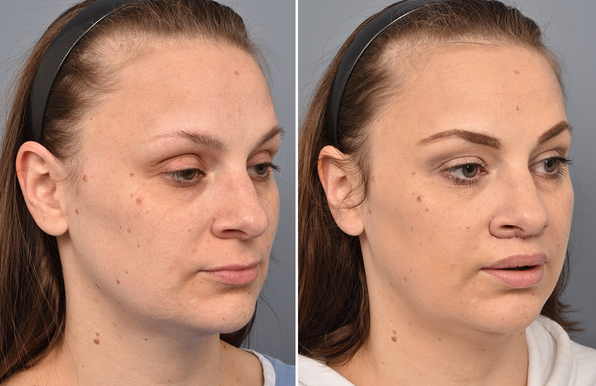 Lip Lift Before & After Gallery - Patient 516970 - Image 5