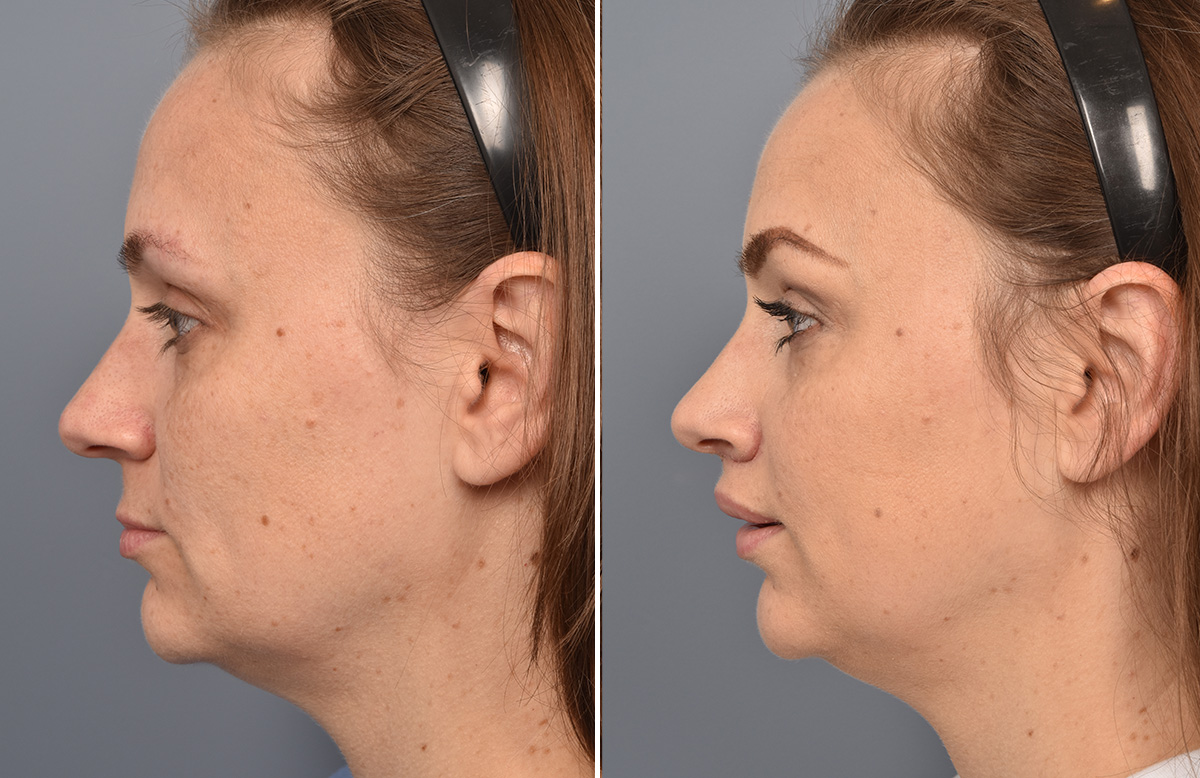 Lip Lift Before & After Gallery - Patient 516970 - Image 8