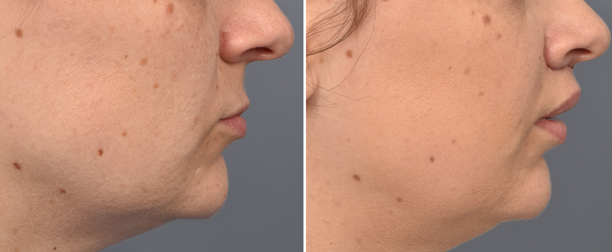 Lip Lift Before & After Gallery - Patient 516970 - Image 2
