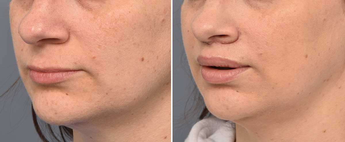 Lip Lift Before & After Gallery - Patient 516970 - Image 3