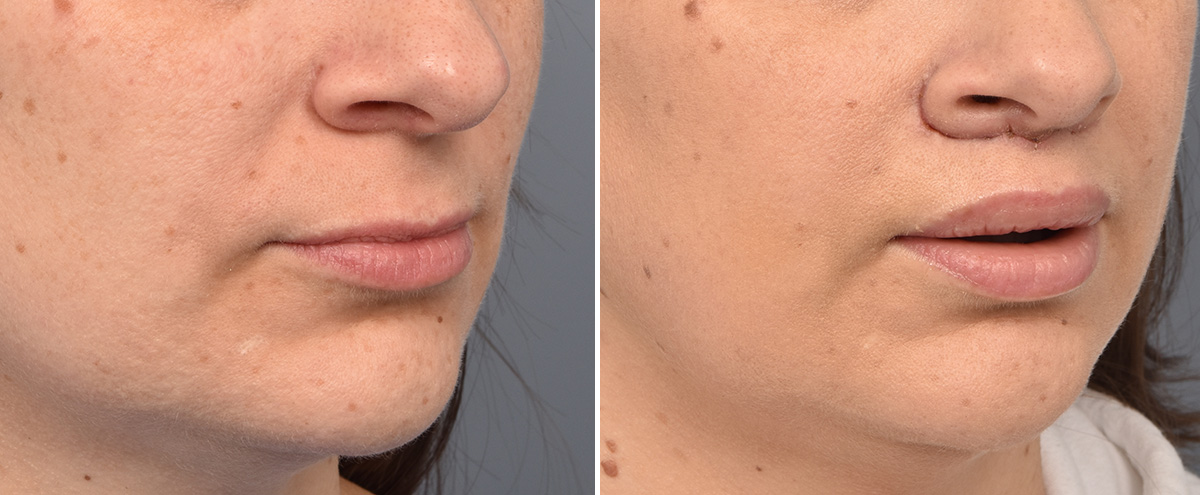 Lip Lift Before & After Gallery - Patient 516970 - Image 1