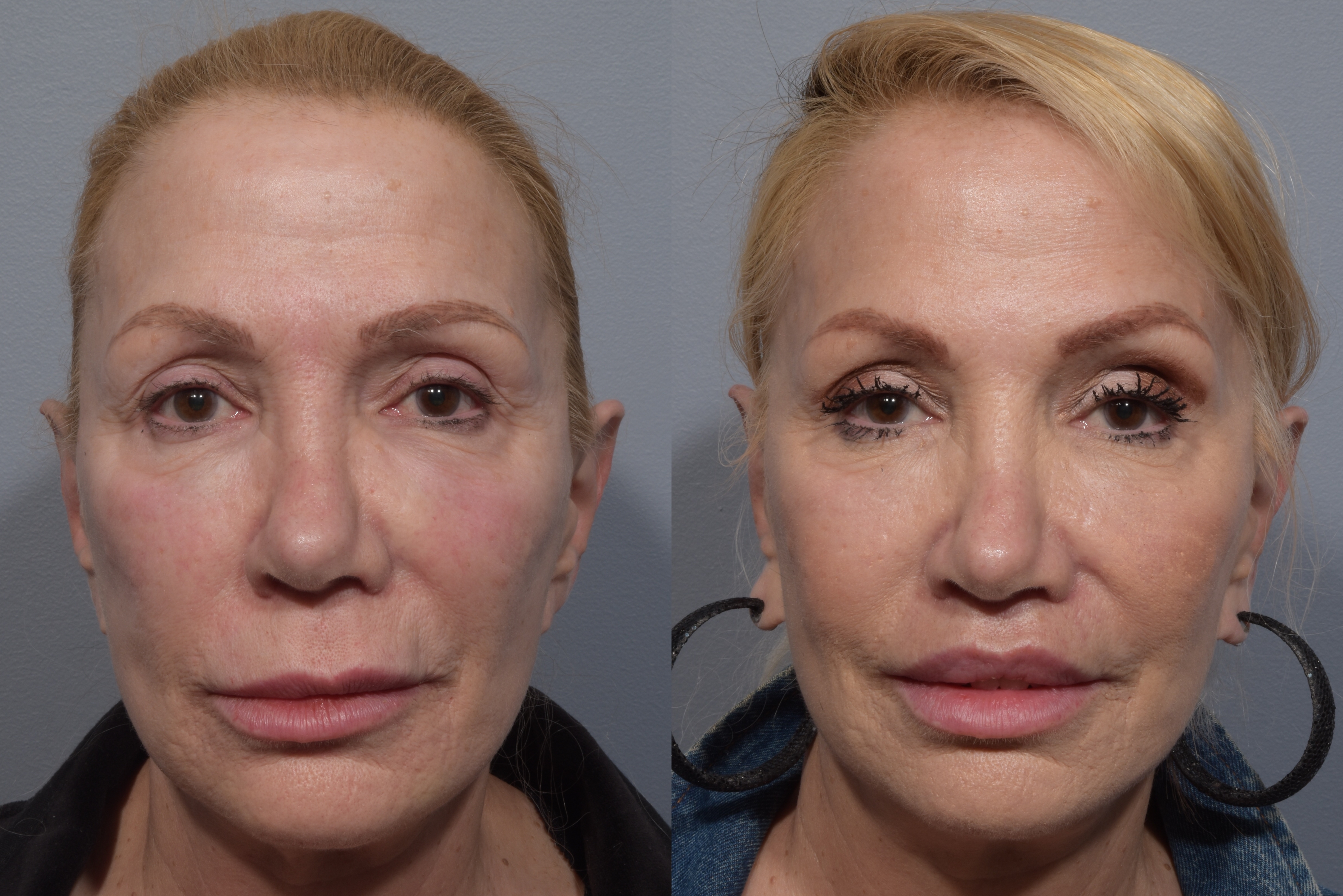 Lip Lift Before & After Gallery - Patient 405605 - Image 6