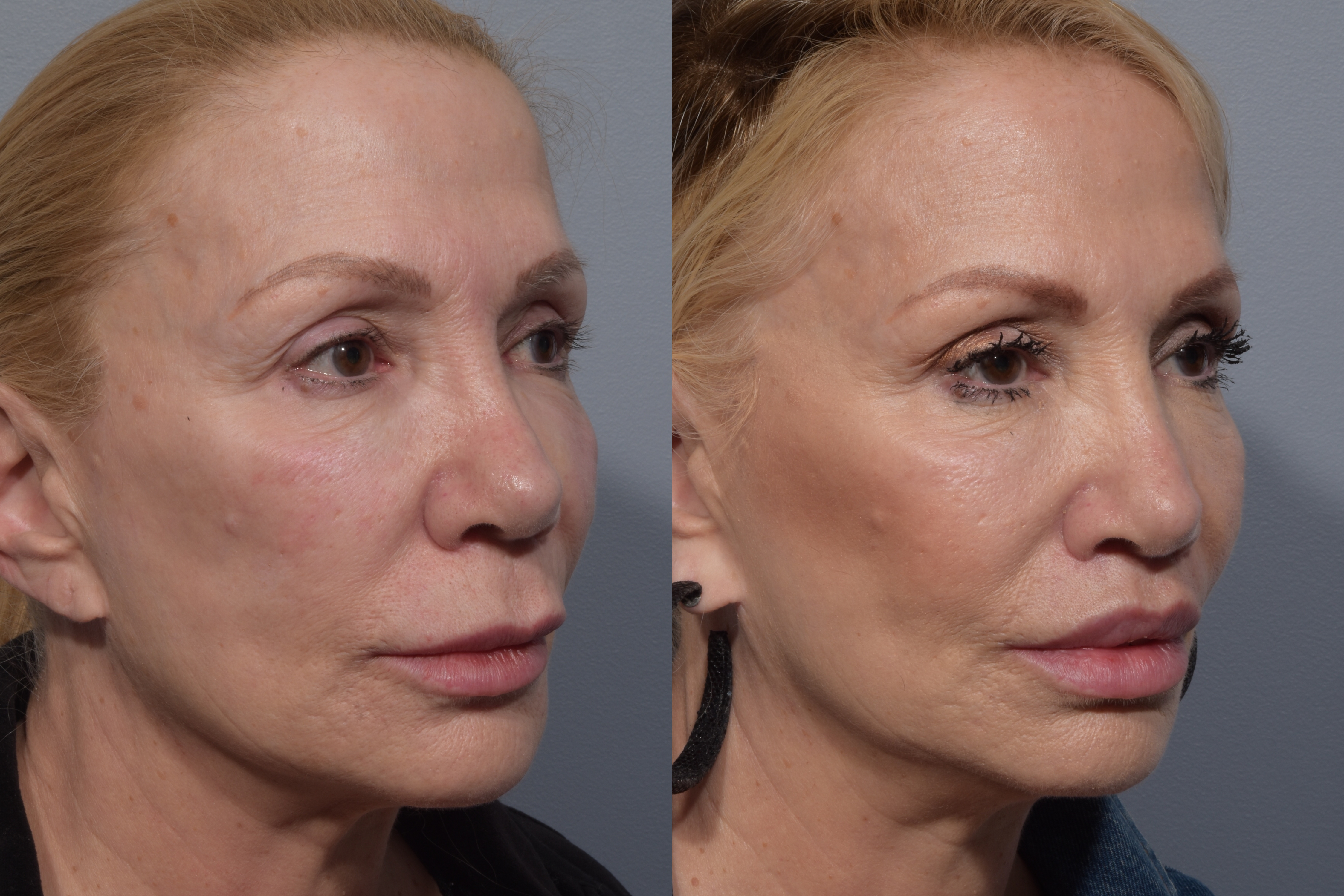 Lip Lift Before & After Gallery - Patient 405605 - Image 7