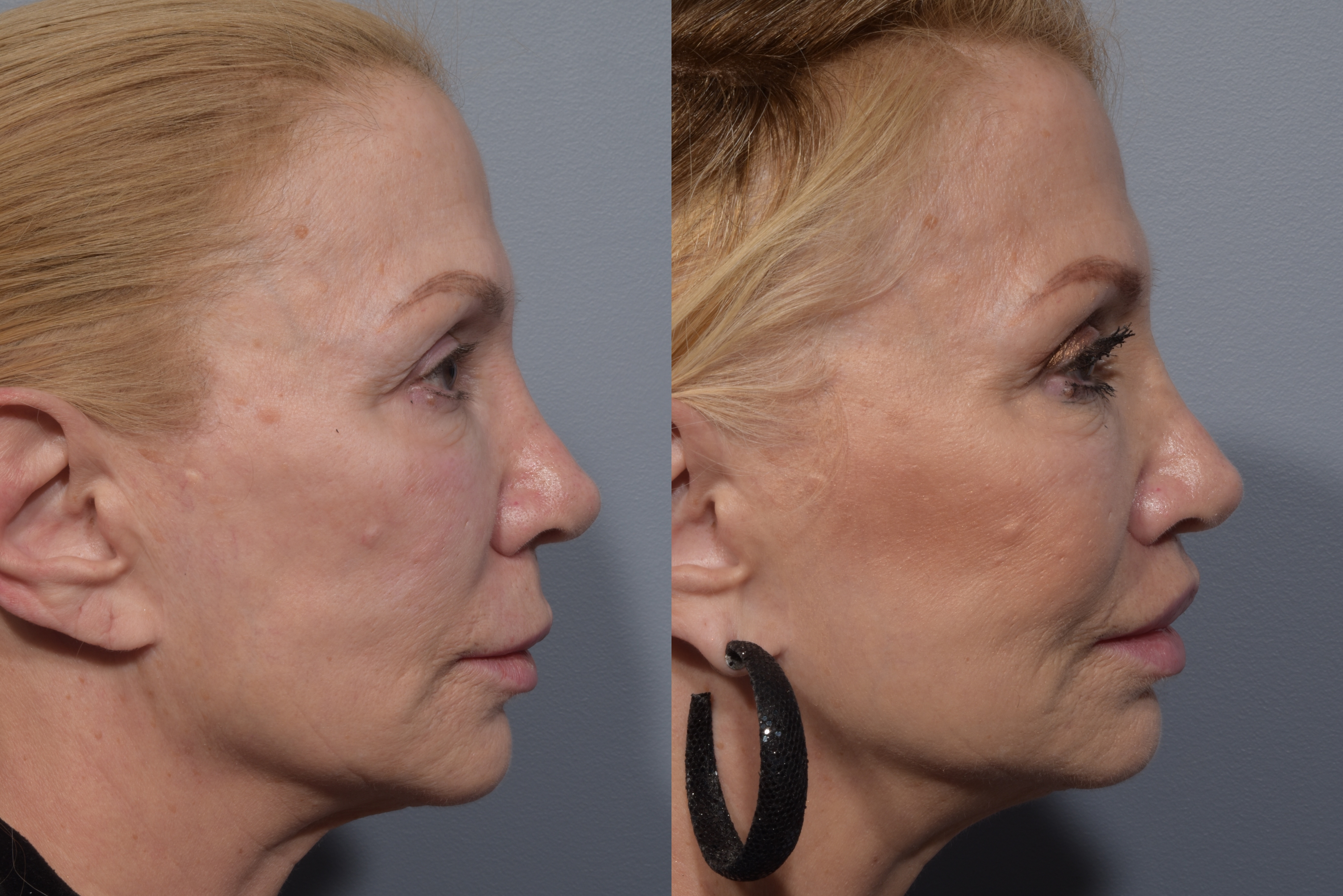Lip Lift Before & After Gallery - Patient 405605 - Image 8