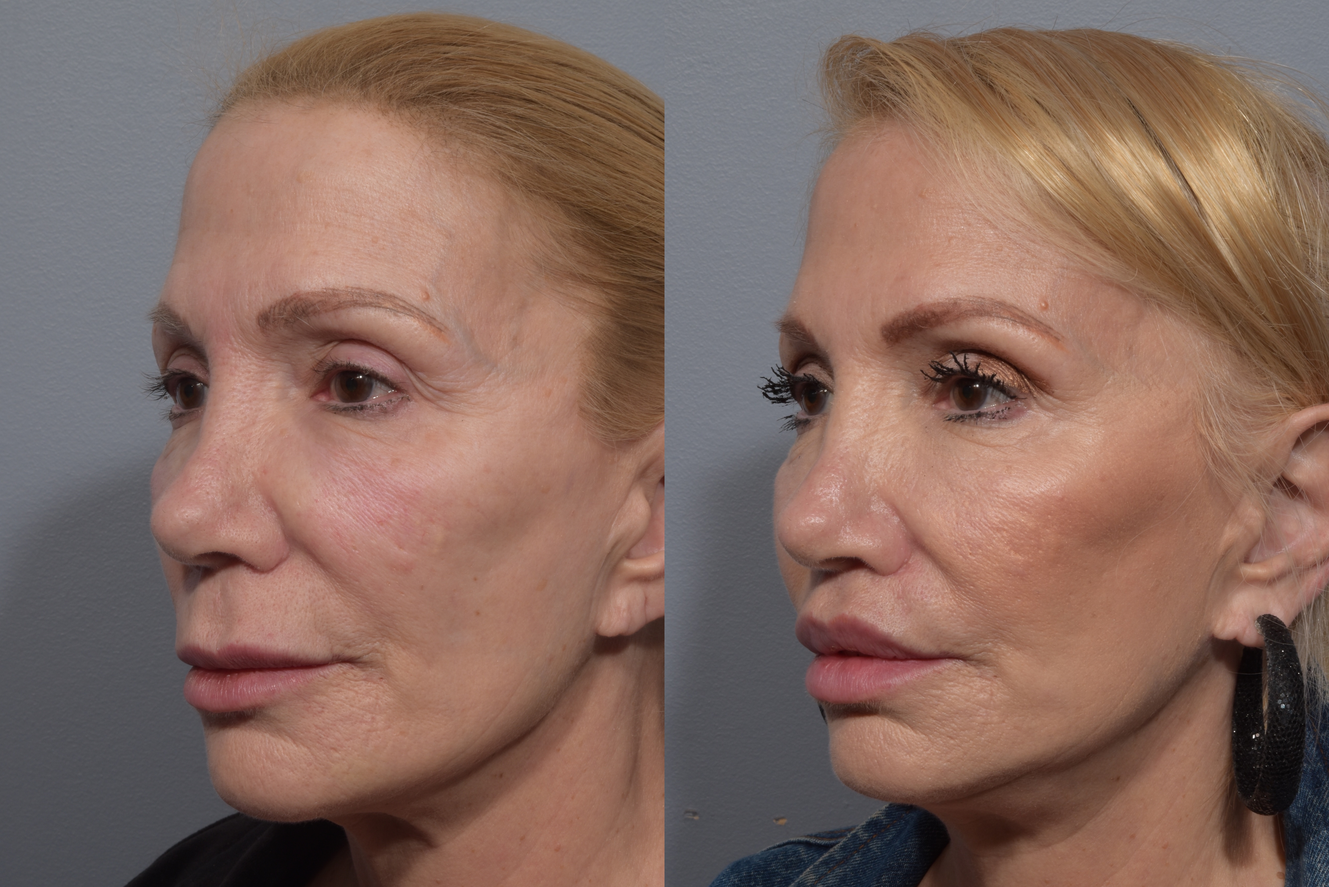 Lip Lift Before & After Gallery - Patient 405605 - Image 9