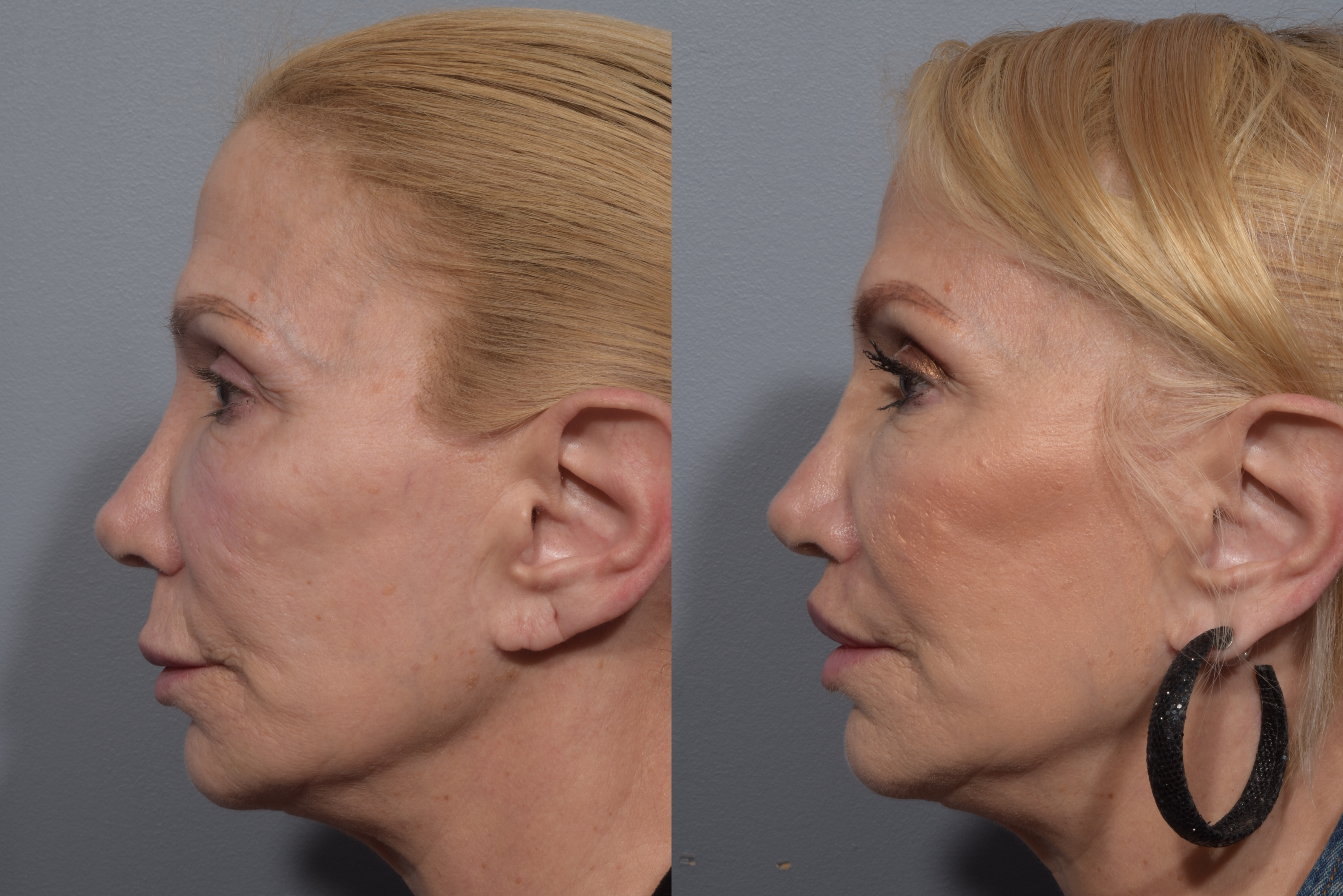 Lip Lift Before & After Gallery - Patient 405605 - Image 10