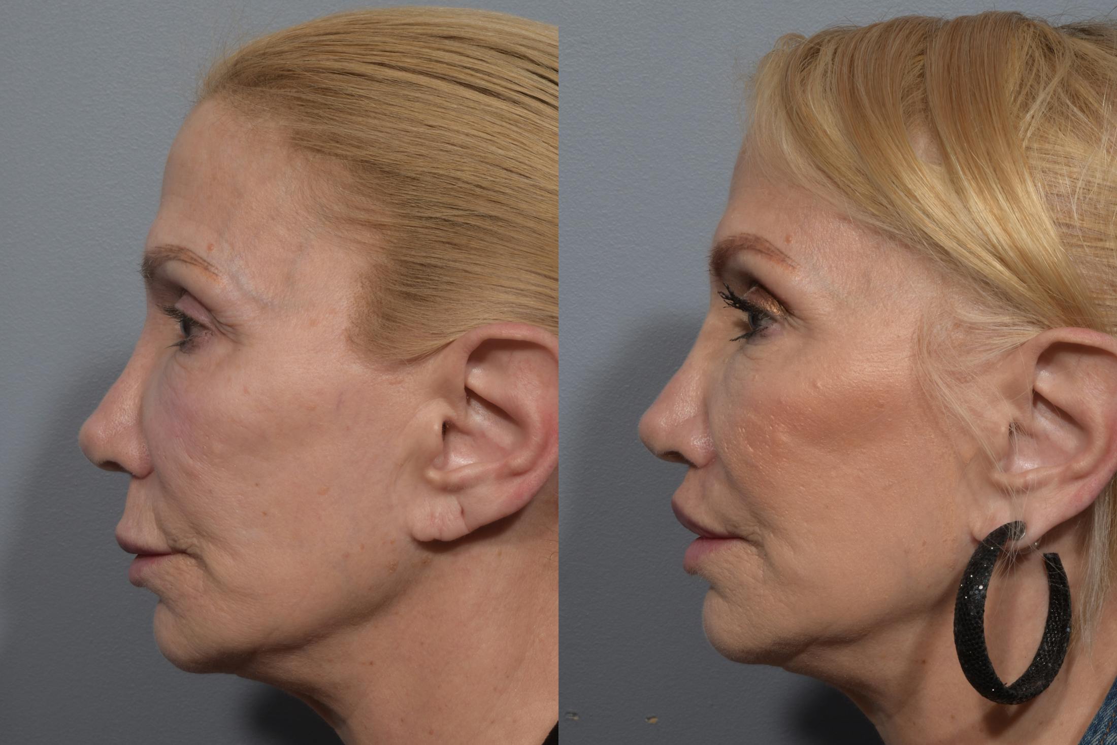 Lip Lift Before & After Gallery - Patient 405605 - Image 10