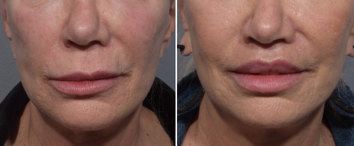 Lip Lift Before & After Gallery - Patient 405605 - Image 1