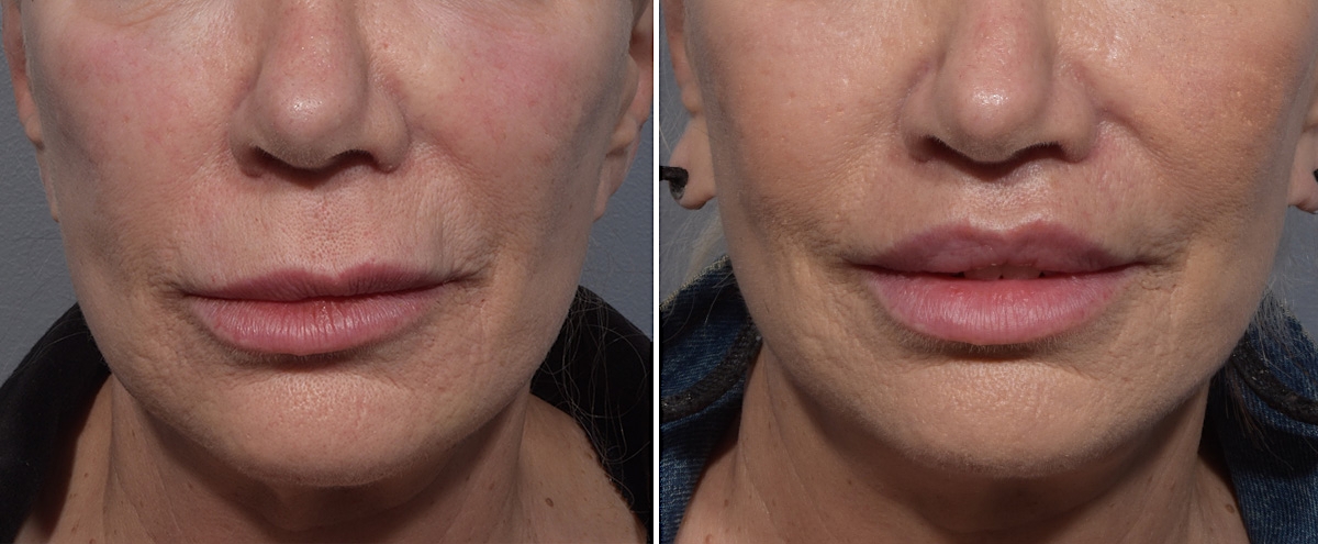 Lip Lift Before & After Gallery - Patient 405605 - Image 1