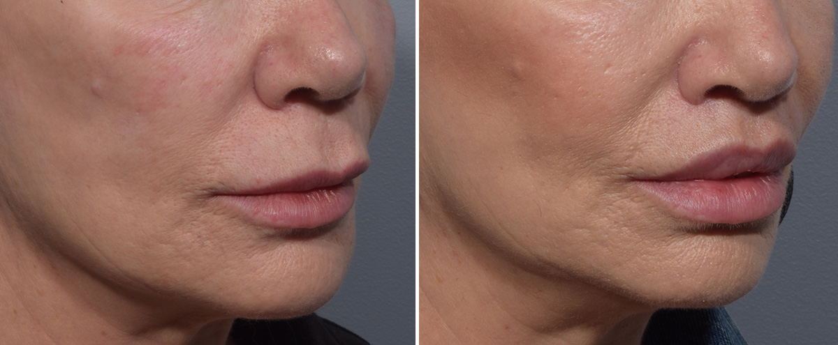 Lip Lift Before & After Gallery - Patient 405605 - Image 2