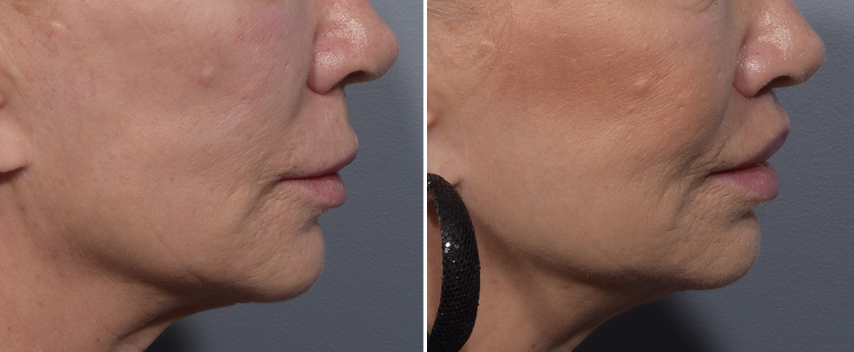 Lip Lift Before & After Gallery - Patient 405605 - Image 3