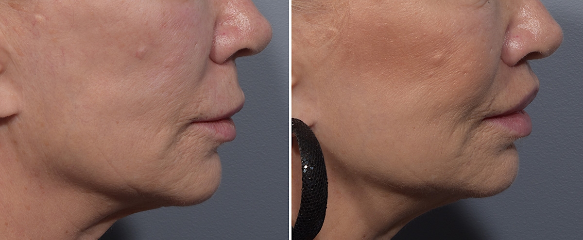 Lip Lift Before & After Gallery - Patient 405605 - Image 3