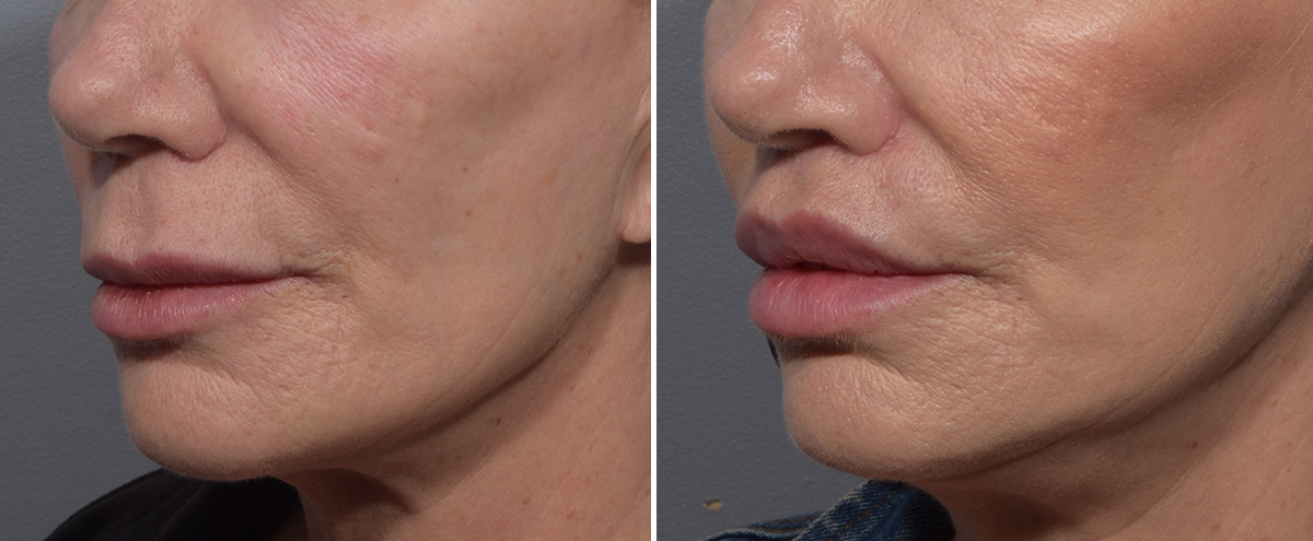 Lip Lift Before & After Gallery - Patient 405605 - Image 4