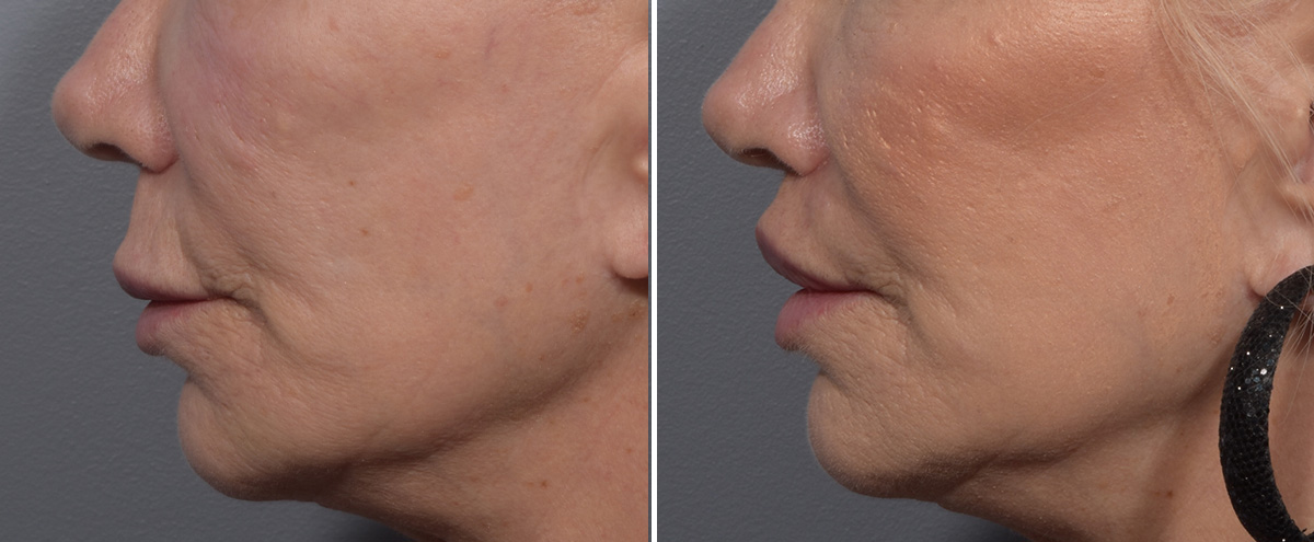 Lip Lift Before & After Gallery - Patient 405605 - Image 5