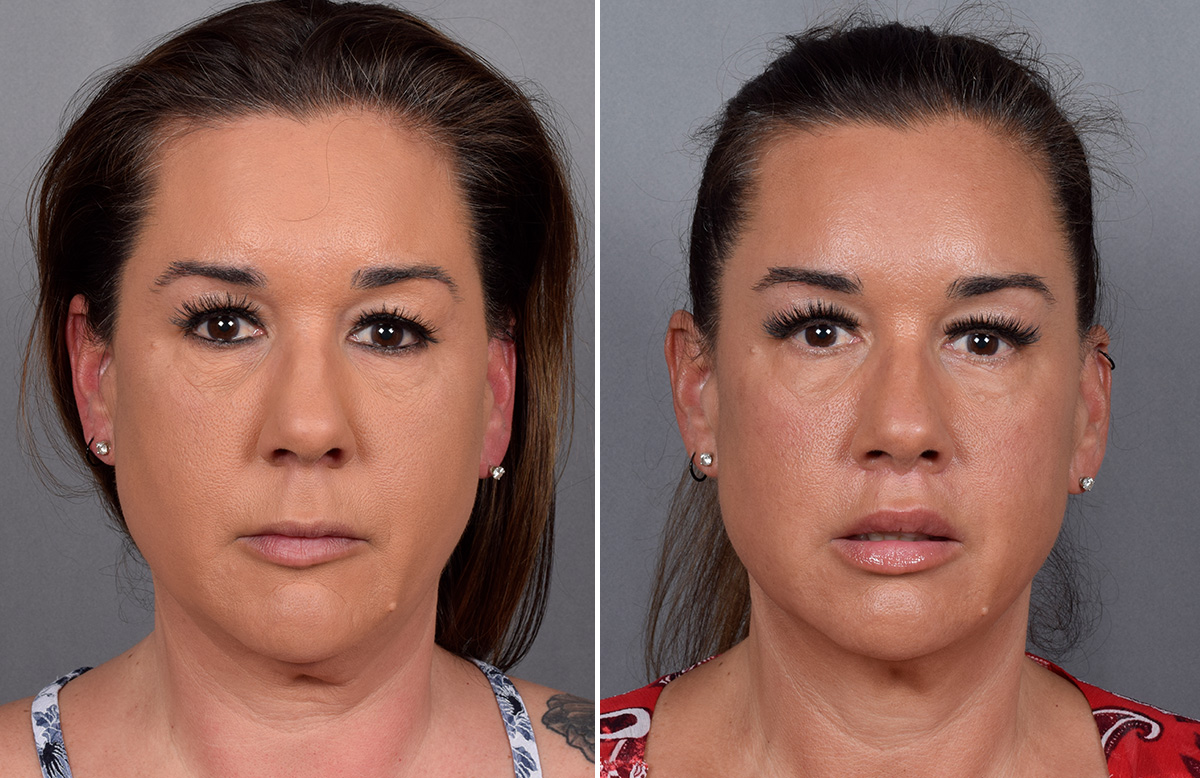 Lip Lift Before & After Gallery - Patient 296551 - Image 7