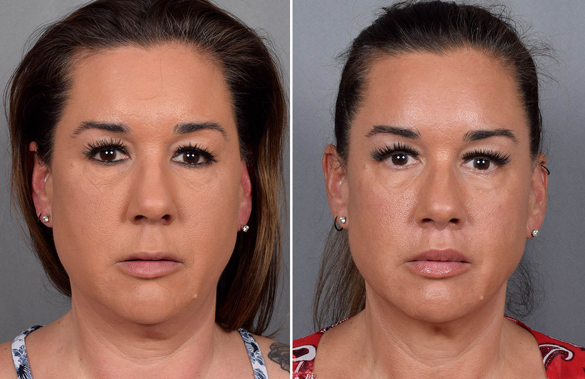 Lip Lift Before & After Gallery - Patient 296551 - Image 8