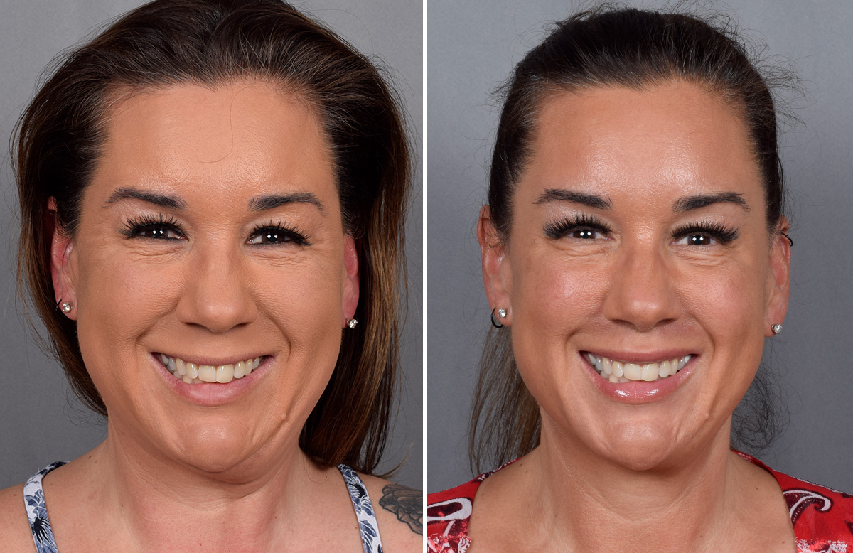 Lip Lift Before & After Gallery - Patient 296551 - Image 9