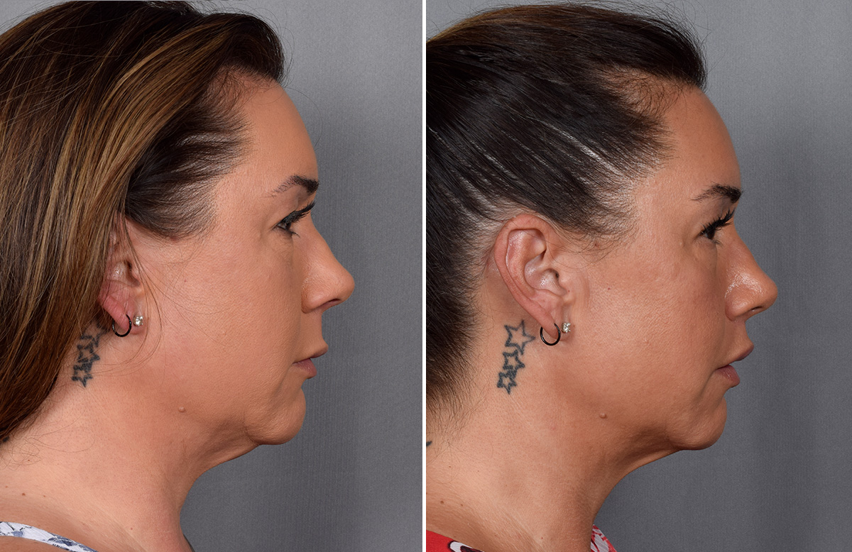 Lip Lift Before & After Gallery - Patient 296551 - Image 11