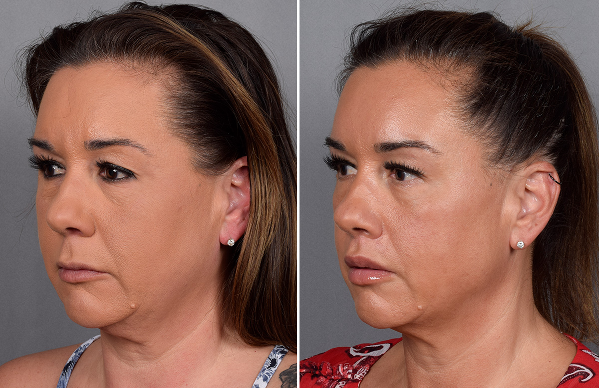 Lip Lift Before & After Gallery - Patient 296551 - Image 12