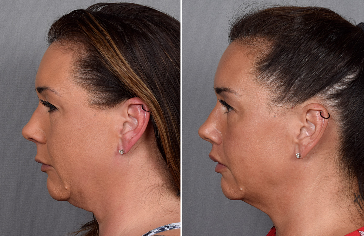 Lip Lift Before & After Gallery - Patient 296551 - Image 13