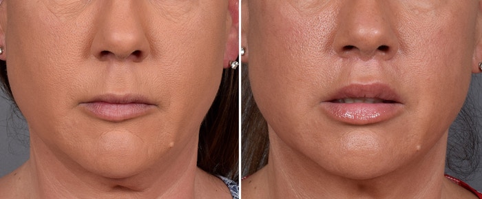 Lip Lift Before & After Gallery - Patient 296551 - Image 1