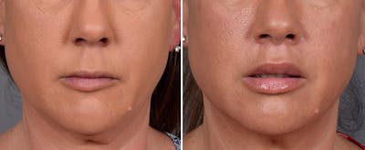Lip Lift Before & After Gallery - Patient 296551 - Image 1