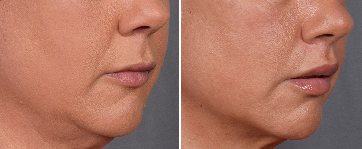 Lip Lift Before & After Gallery - Patient 296551 - Image 3