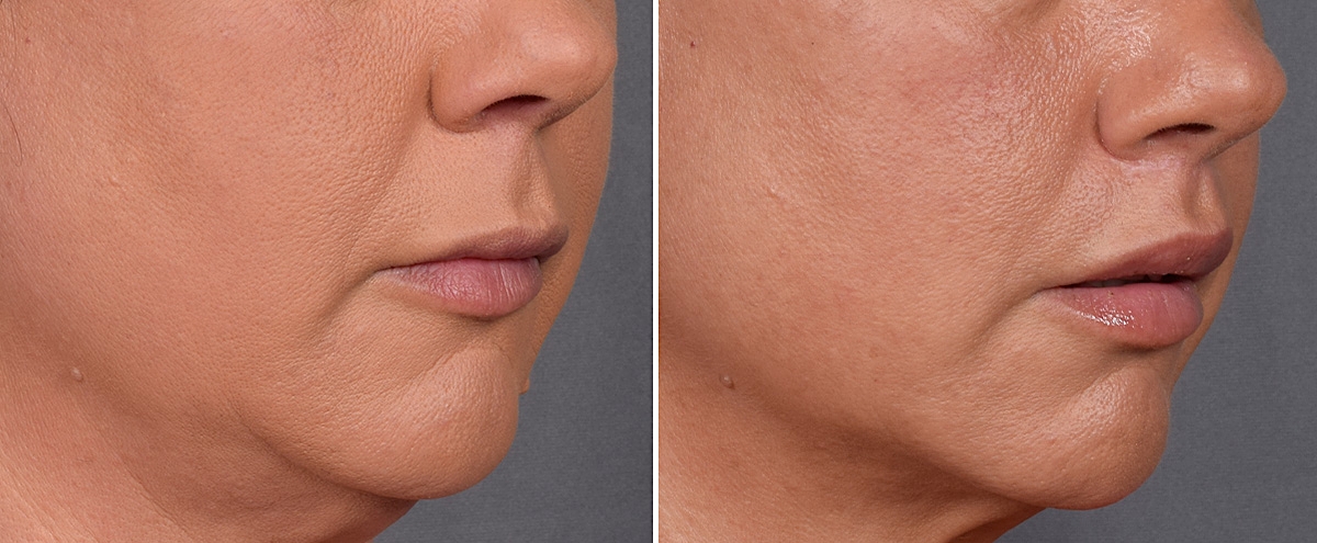 Lip Lift Before & After Gallery - Patient 296551 - Image 3