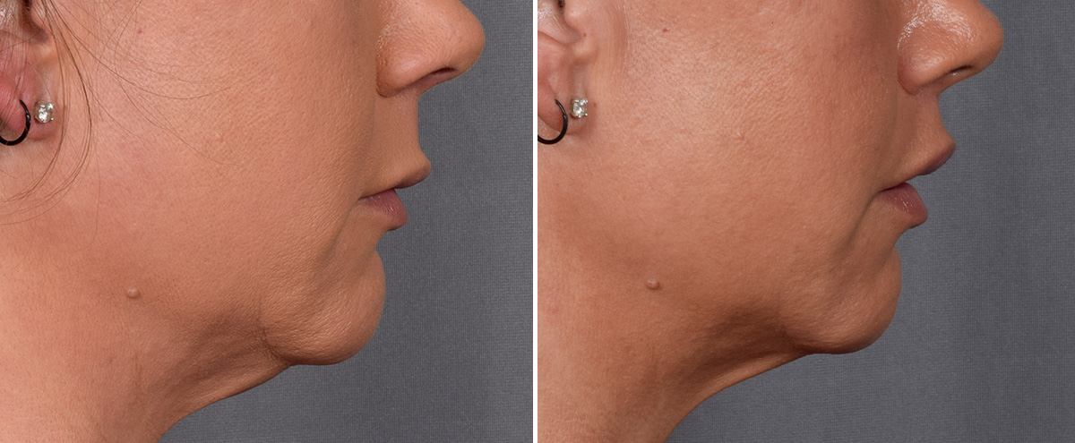 Lip Lift Before & After Gallery - Patient 296551 - Image 4