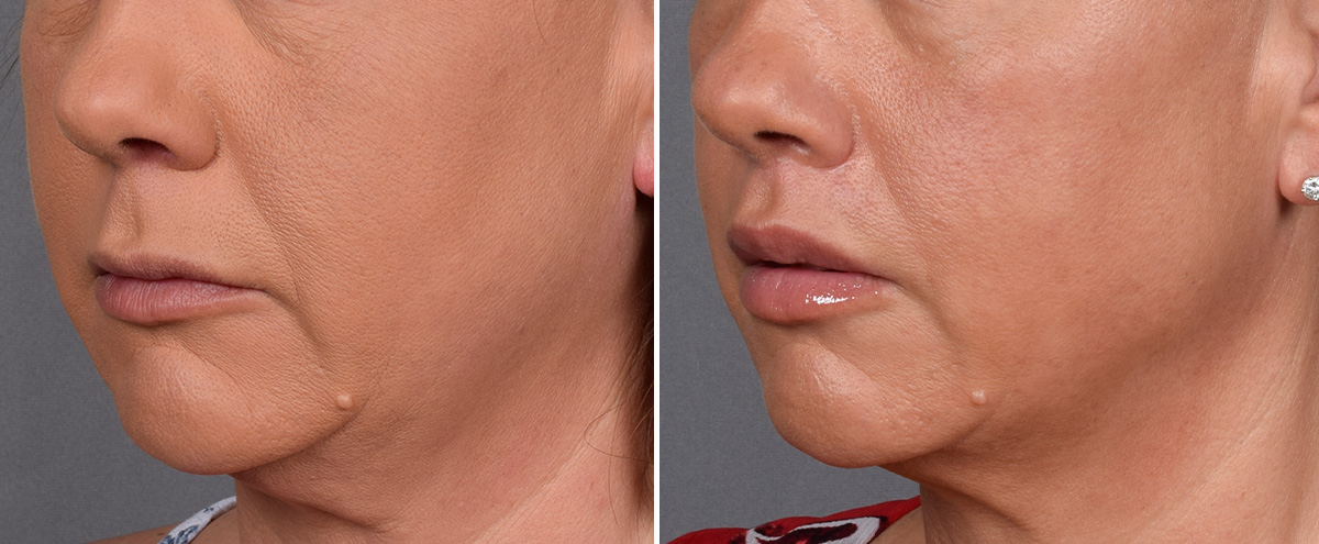 Lip Lift Before & After Gallery - Patient 296551 - Image 5