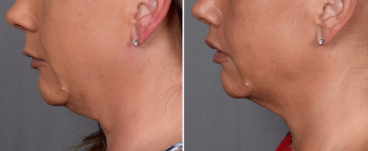 Lip Lift Before & After Gallery - Patient 296551 - Image 6