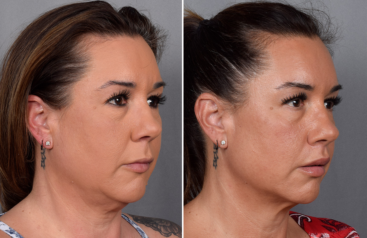 Lip Lift Before & After Gallery - Patient 296551 - Image 10