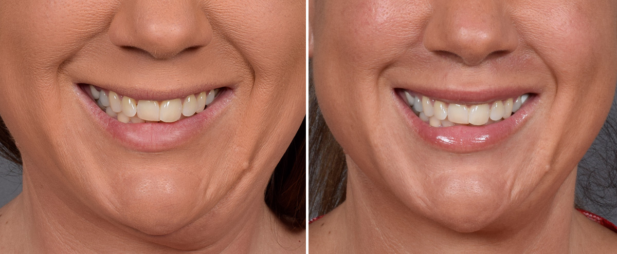 Lip Lift Before & After Gallery - Patient 296551 - Image 2