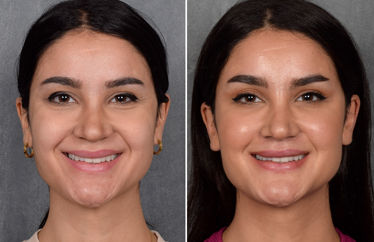 Lip Lift Before & After Gallery - Patient 379894 - Image 8
