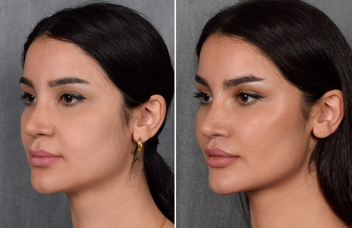 Lip Lift Before & After Gallery - Patient 379894 - Image 11